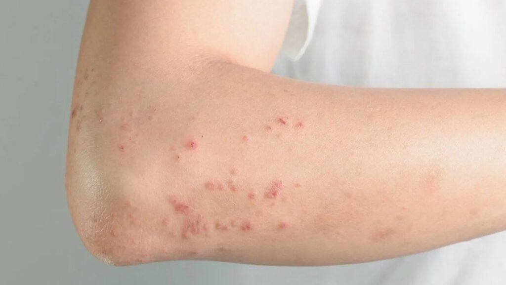 Bệnh Rubella ở Phụ Nữ Mang Thai: Hiểu Rõ để Bảo Vệ Con Yêu