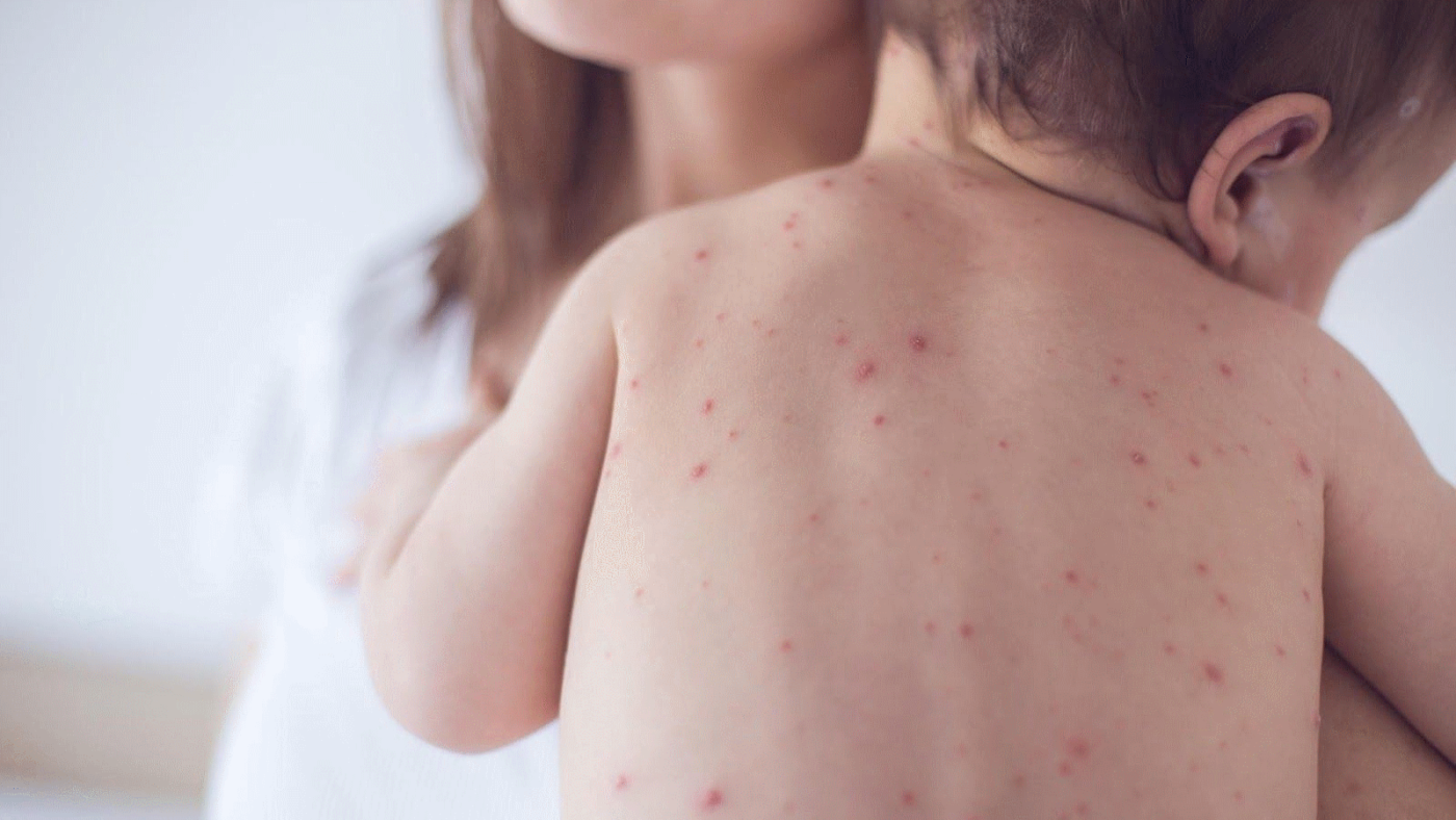 Bệnh Rubella ở Phụ Nữ Mang Thai: Hiểu Rõ để Bảo Vệ Con Yêu
