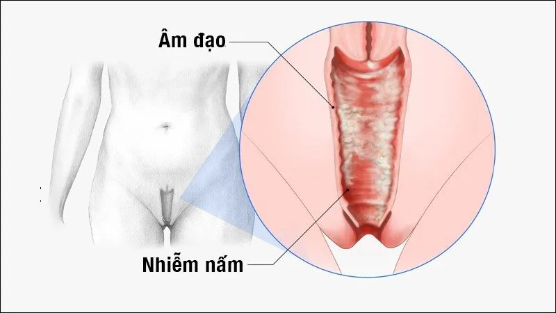 Nấm Âm Đạo Khi Mang Thai: Tất Tần Tật Mẹ Bầu Cần Biết