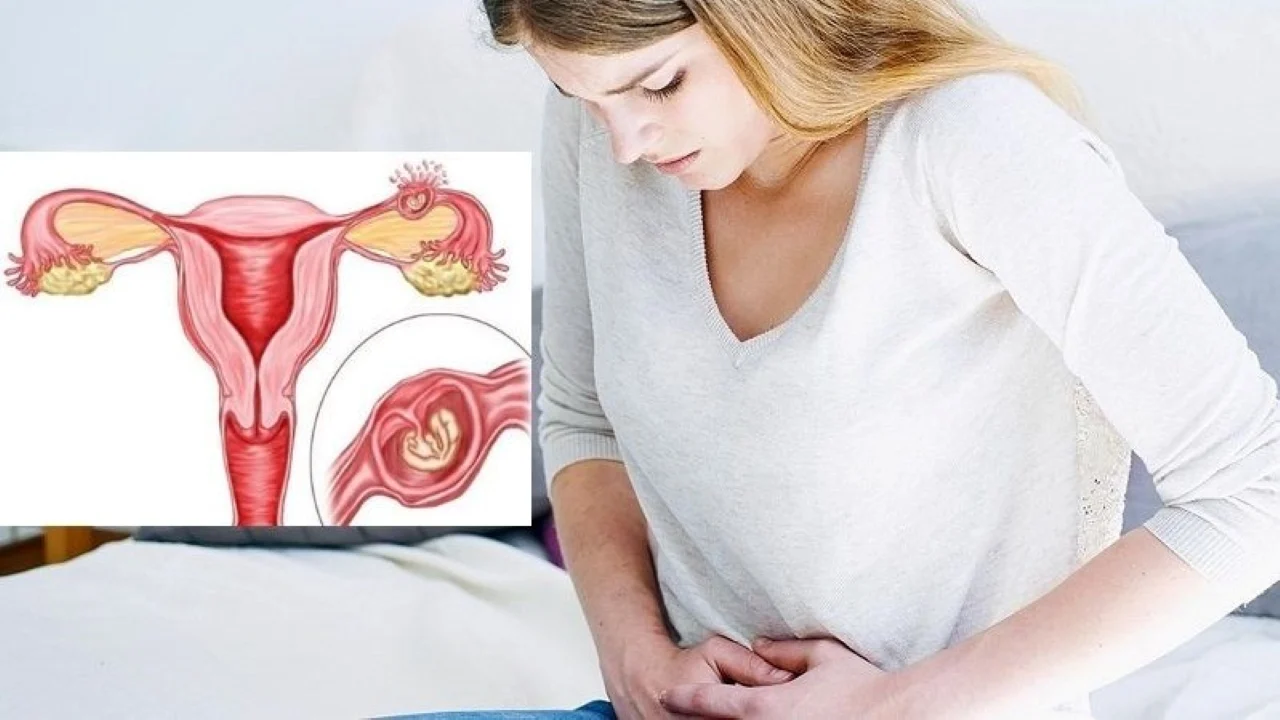 Dấu Hiệu Mang Thai Ngoài Tử Cung Tháng Đầu: Nhận Biết Sớm Để Bảo Vệ Sức Khỏe